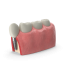 Education Tooth Implant Model.H03.2k